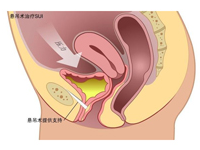 微吊带术治疗女性压力性尿失禁
